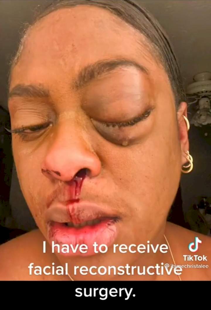 From 'God when' to 'God forbid' - Woman who flaunted her boyfriend's love for her and hailed him as the best shows injury he inflicted on her (video)