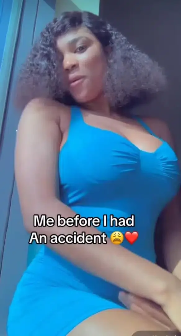 Lady shares transformation after involvement in ghastly accident