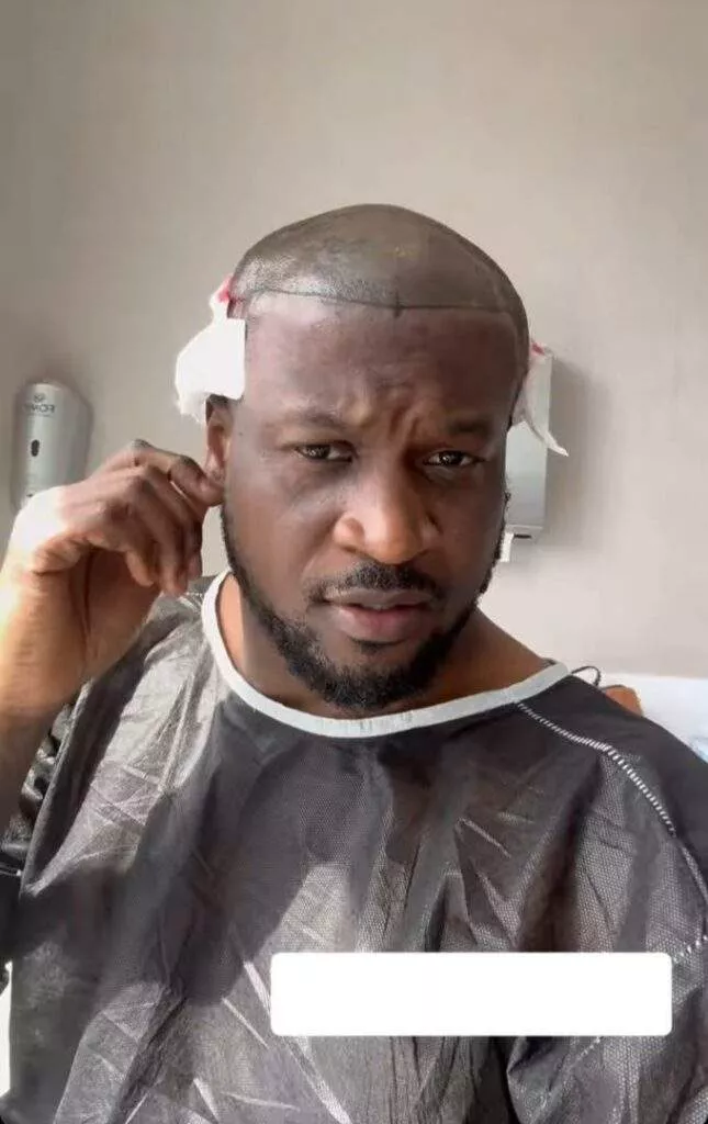 Peter Okoye undergoes hair transplant in Turkey