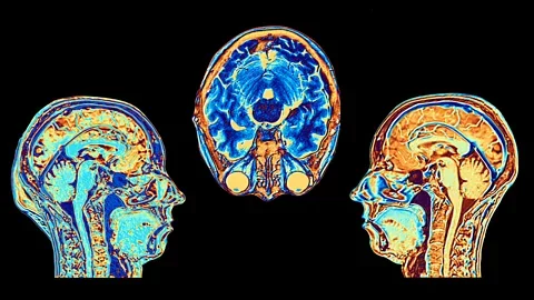 Getty Images The locus coeruleus is located in the brain stem, and contains just 50,000 cells (Credit: Getty Images)