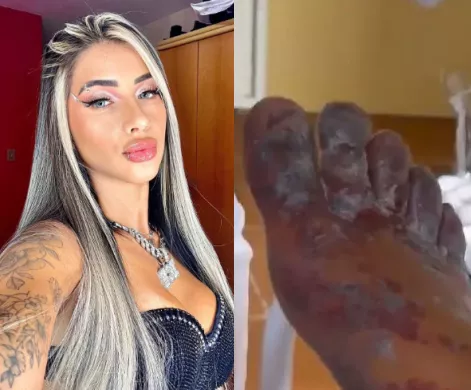Influencer may never be able to walk again after taking part in online "challenge" that turned her feet black