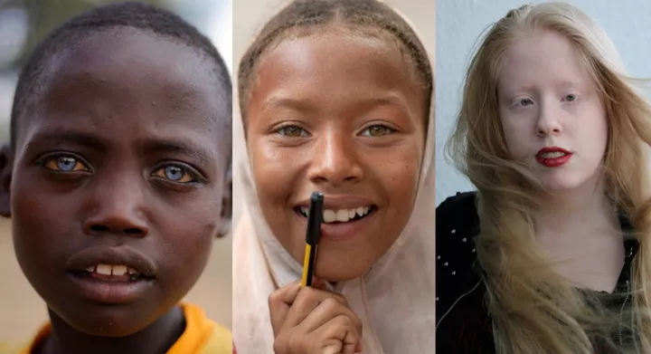 5 types of albinos and how they look (Photos)